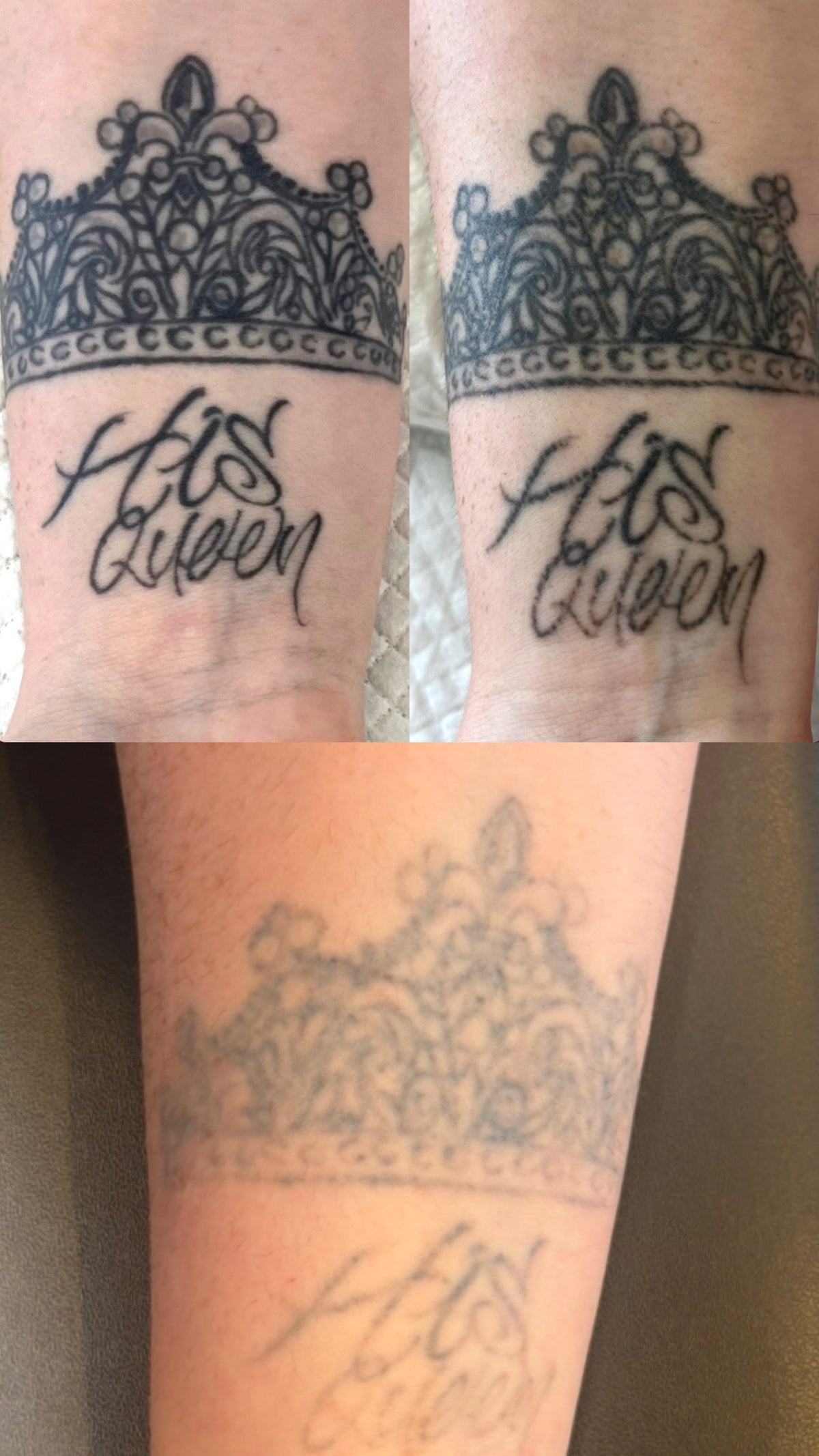 Laser Tattoo Removal (Cosmetic and Body Art Removal) Ebook Only
