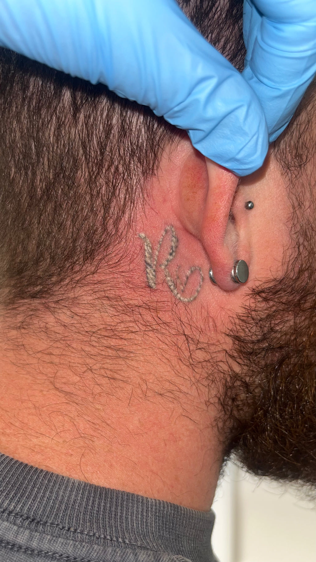 Laser Tattoo Removal (Cosmetic and Body Art Removal) Ebook Only