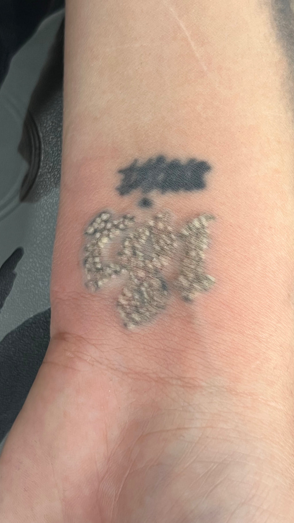Laser Tattoo Removal (Cosmetic and Body Art Removal) Ebook Only