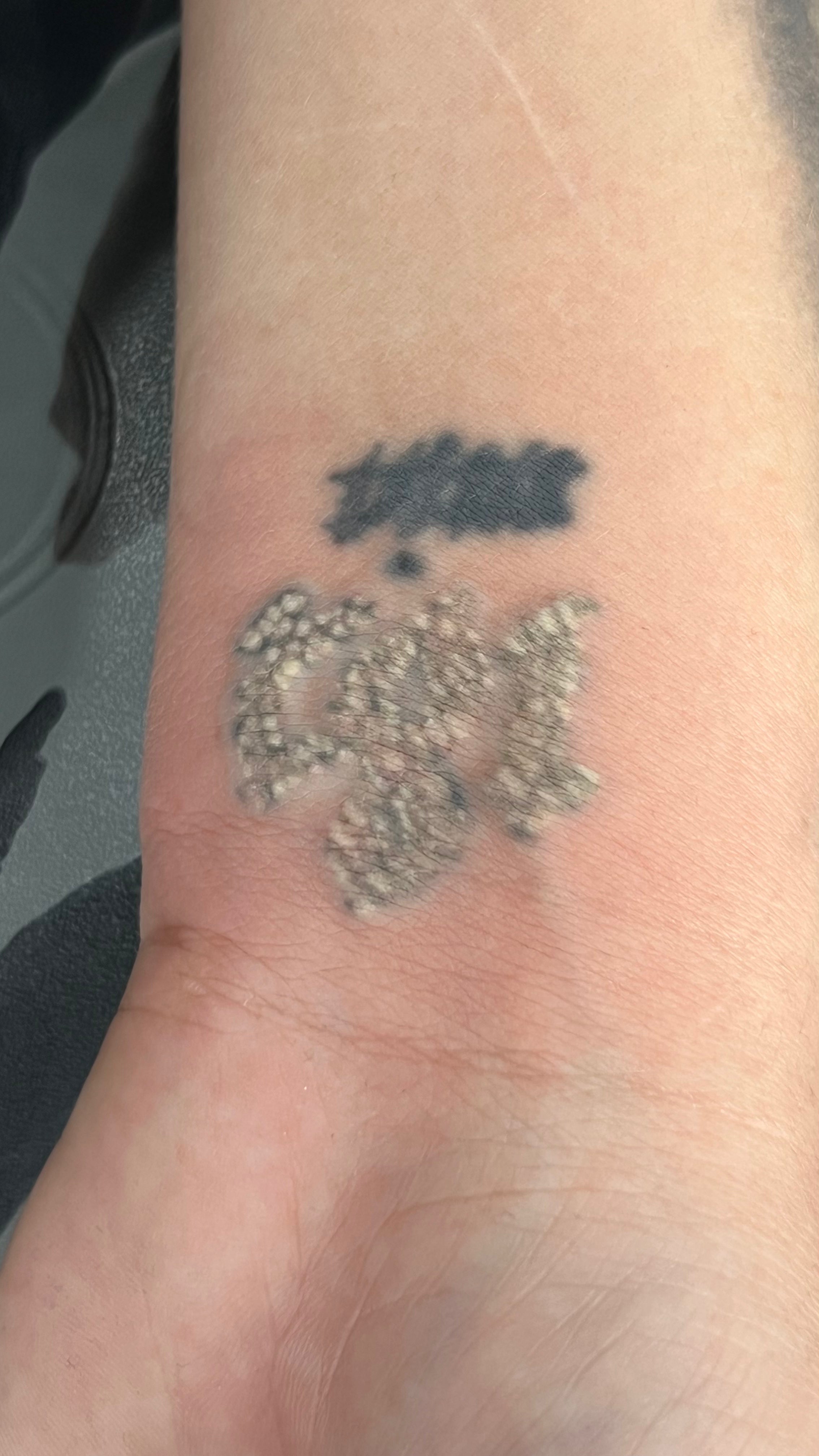 Laser Tattoo Removal (Cosmetic and Body Art Removal) Ebook Only